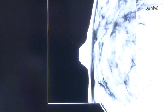 Povara cancerului de sân în România. Beneficiile investiţiei într-un program de screening pentru cancerul de sân