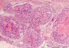 Studiile clinice în oncologie