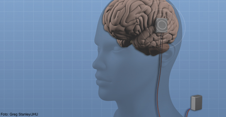 Implant epilepsie