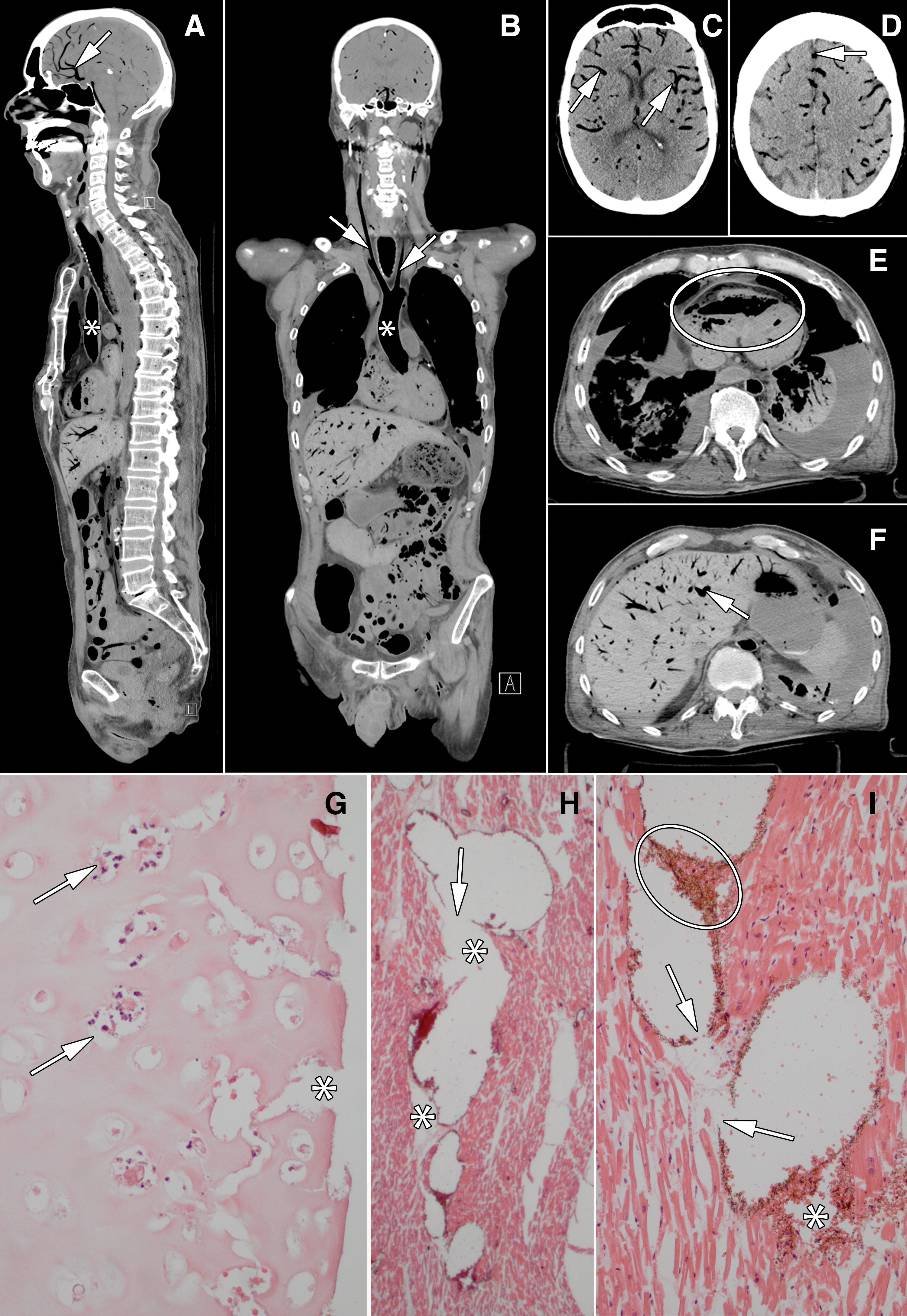 Figura. Diagnostic post-mortem minim invaziv. Imagini fotomicrografice ale țesuturilor după investigația CT. Suspiciunea clinică de embolie pulmonară sau tamponadă cardiacă nu a corespuns cu identificarea infarctului miocardic și tromboemboliei la autopsia convențională sau cu diagnosticarea emboliei gazoase la autopsia minim invazivă. Comitetul de specialiști a conchis că diagnosticul corect a fost cel minim invaziv. A, B, C, D, E, F – imaginile CT arată difuzia aerului în sistemul cardiovascular; G – imagine fotomicrografică a porțiunii luminale a traheei arată dispariția mucoasei și submucoasei. Cartilajul traheal este necrozat, prezentând lacune, detritusuri nucleare și fisuri; H, I – imagini fotomicrografice ale miocardului arată prezența aerului în vasele de sânge, care împinge eritrocitele la peretele vascular și cauzează ruptura acestuia. Sursa: Blokker et al., Radiology, 2018