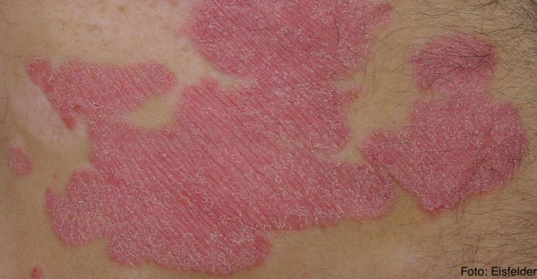 Psoriazis în plăci